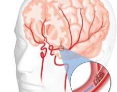 Recuperare dopo un Ictus: quanto è possibile?