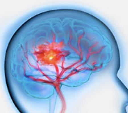 In Italia l’ictus è la terza causa di morte. Circa 196.000 casi l’anno